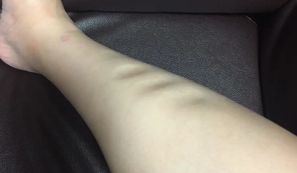 むくみ足